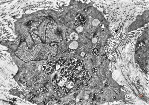 M,40y. | granular cell tumor M,40y. | granular cell tumor